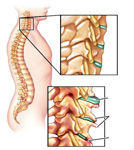 Nolakoa den osteochondrosia