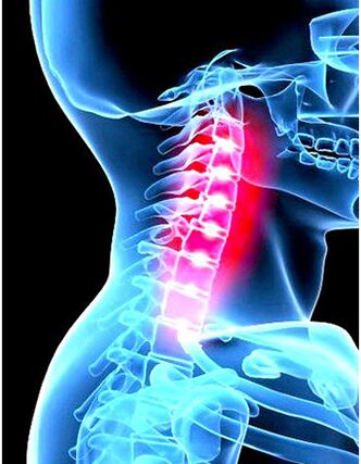 Osteokonondrosaren irudi klinikoa