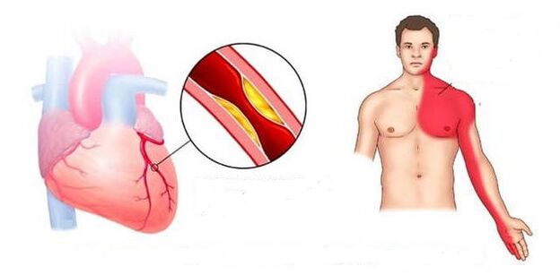 Sindrome kardiala